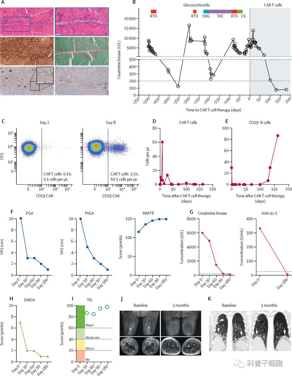 《柳叶刀》：首次成功利用CAR-T细胞治疗严重肌肉炎症