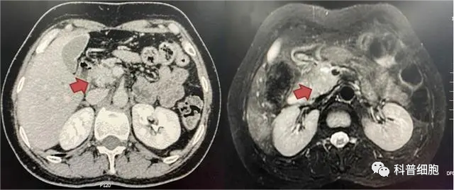 真实案例：胰腺癌多次治疗无果，细胞疗法显著延长生存期！