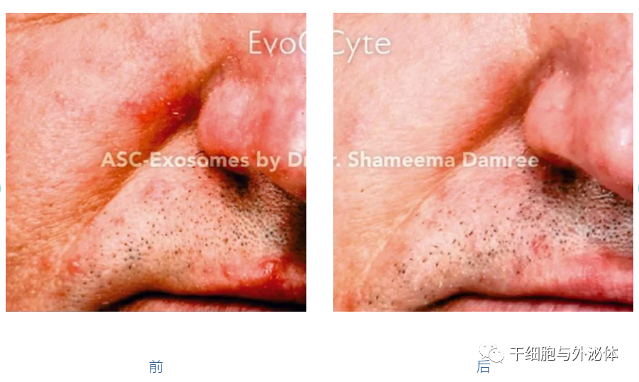 英国顶级美容诊所：外泌体是衰老、炎症性皮肤病全新一代疗法