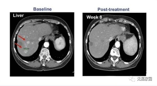 重磅！T细胞疗法再度发力！药明巨诺完成首例患者回输治疗，剑指晚期肝癌！