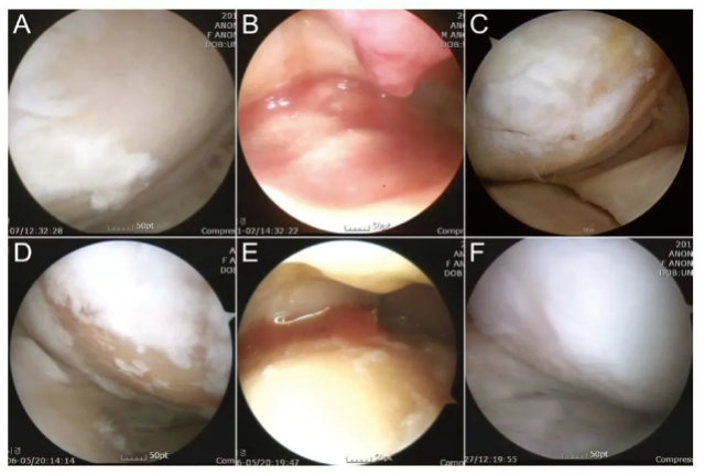 4个案例表明：干细胞能提升半月板损伤修复和愈合速度