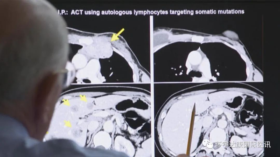 ​晚期癌症“奇迹”缓解！用自己的免疫细胞杀灭肿瘤成为现实​！