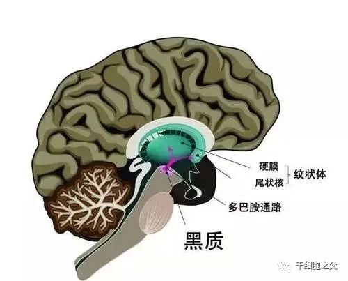 干细胞治疗帕金森病的临床研究及案例