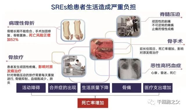 靶向治疗联合NK细胞疗法，让肺癌骨转移患者实现长期生存