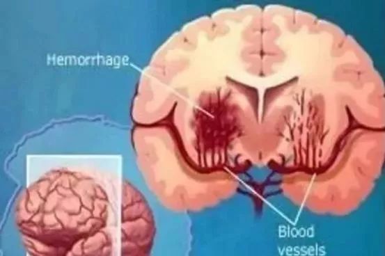 干细胞治疗脑出血后遗症，技术有效且安全！