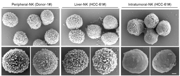 中科大发现NK细胞失去抗肿瘤能力关键机制