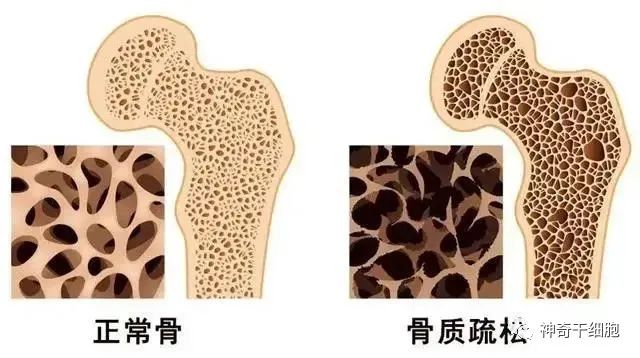 干细胞为健康加“骨”劲，有效改善骨质疏松症