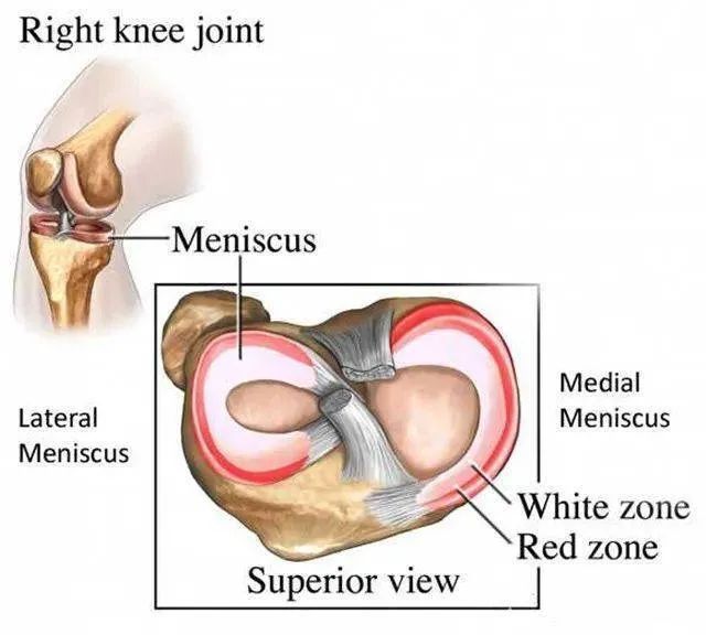 4个案例表明：干细胞能提升半月板损伤修复和愈合速度
