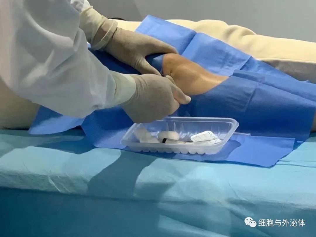 干细胞让骨关节炎患者软骨持续再生