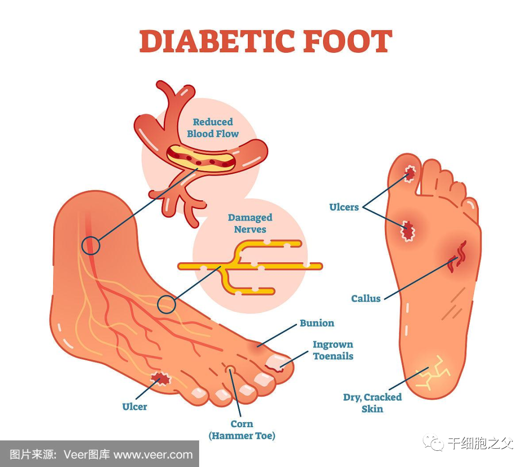 22篇文献证实：间充质干细胞治疗糖尿病足有益！伤口完全闭合率达82%