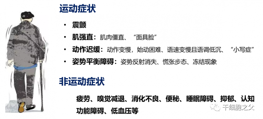 干细胞治疗帕金森病的临床研究及案例