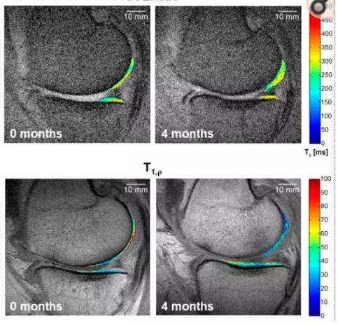 15个案例证实：间充质干细胞治疗膝关节软骨损伤安全有效！
