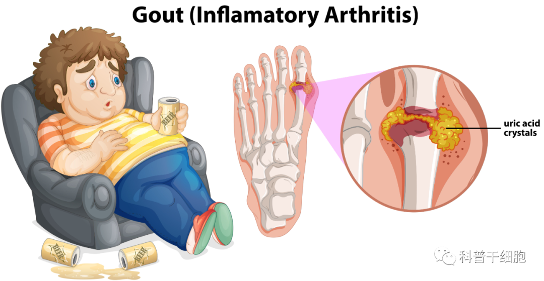 治疗痛风不止有药物，还有神奇的干细胞，止痛更“治痛”！