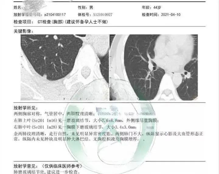 细胞疗法丨肺部结节癌变之前，免疫细胞疗法可使其缩小甚至消失！