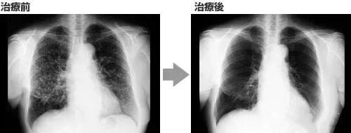 癌症的天敌，最好的医生——NK细胞疗法