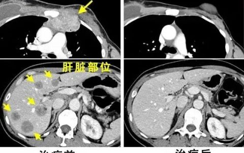 当800亿个免疫细胞输注她身体后，乳腺癌患者实现10年无癌生存