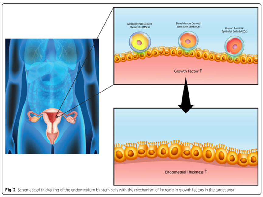 干细胞治疗宫腔粘连的3个临床研究案例