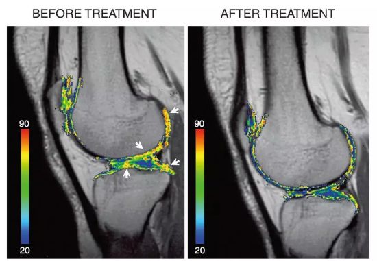 15个案例证实：间充质干细胞治疗膝关节软骨损伤安全有效！