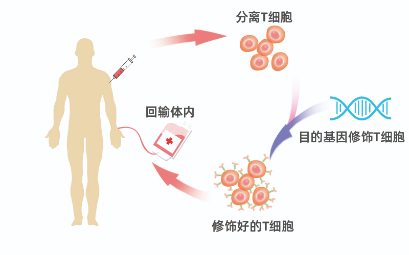 临床招募|徐州医科大学附属医院|CAR-T细胞治疗慢性格林巴利（吉兰-巴雷）综合征患者