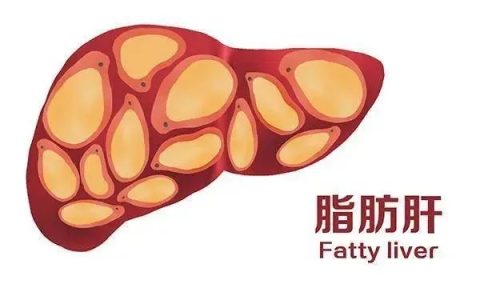 干细胞有效改善脂肪肝，帮助患者远离肝病风险