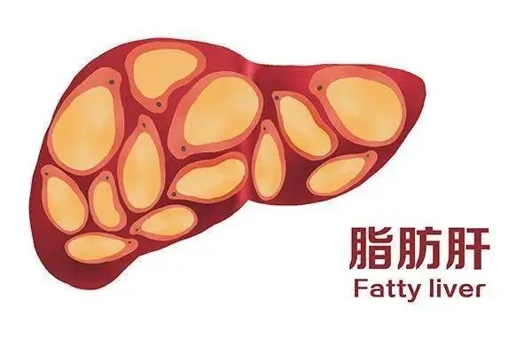 干细胞有效改善脂肪肝，帮助患者远离肝病风险