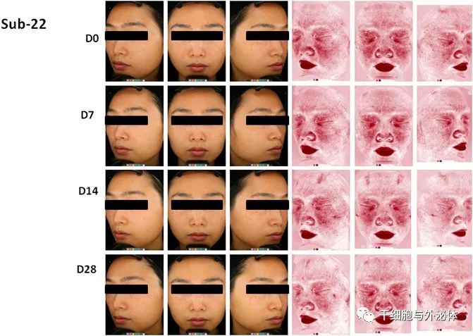 中山大学附属第三医院：外泌体作为女性敏感皮肤的新型治疗方法