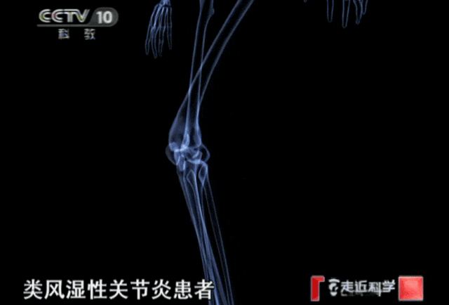 央视CCTV：痛苦了11年的类风湿性关节炎，干细胞让她重回生活正轨