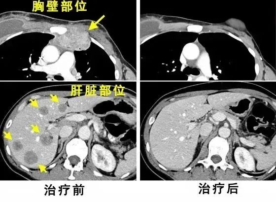 当免疫细胞进入她的身体后，乳腺癌患者实现7年无癌生活