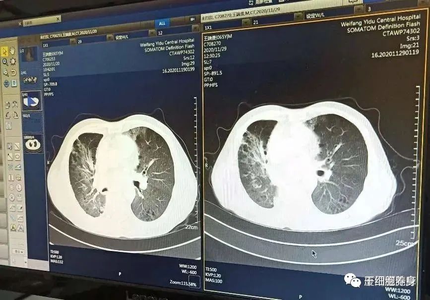 干细胞治疗肺纤维化的临床案例