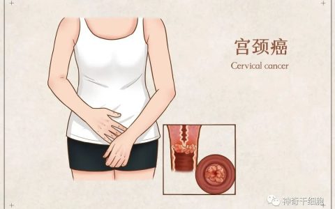 案例分享 | 免疫细胞疗法成功治愈宫颈癌患者