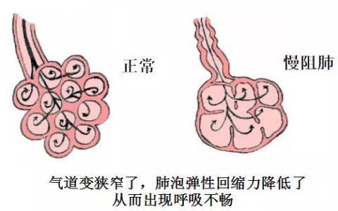 干细胞治疗慢阻肺的临床进展及案例分享