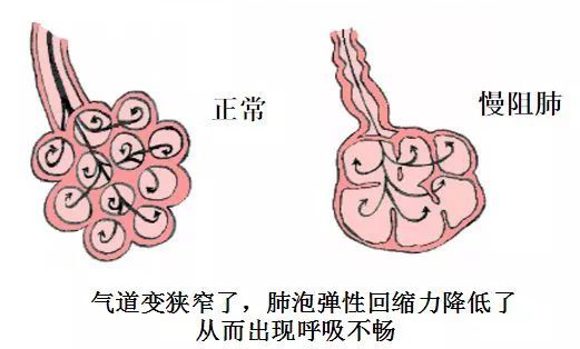 干细胞治疗慢阻肺的临床进展及案例分享