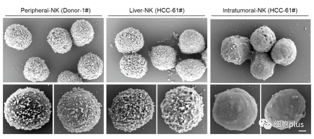 当患者无法“重整”体内NK细胞“雄风”时，输注外源性NK细胞成为了抗肿瘤的有效手段