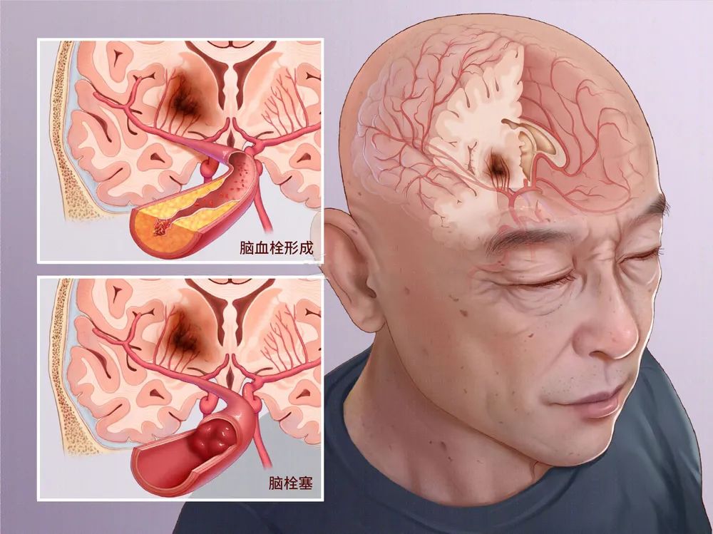 传统疗法治疗脑梗不甚理想，最新技术“干细胞移植”重建脑组织