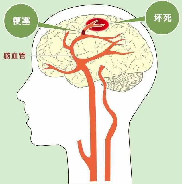 脑梗后遗症，让干细胞来为你分忧解难