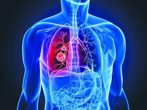 肺部结节“缩小术”：在癌变前，免疫细胞可使其缩小甚至消失