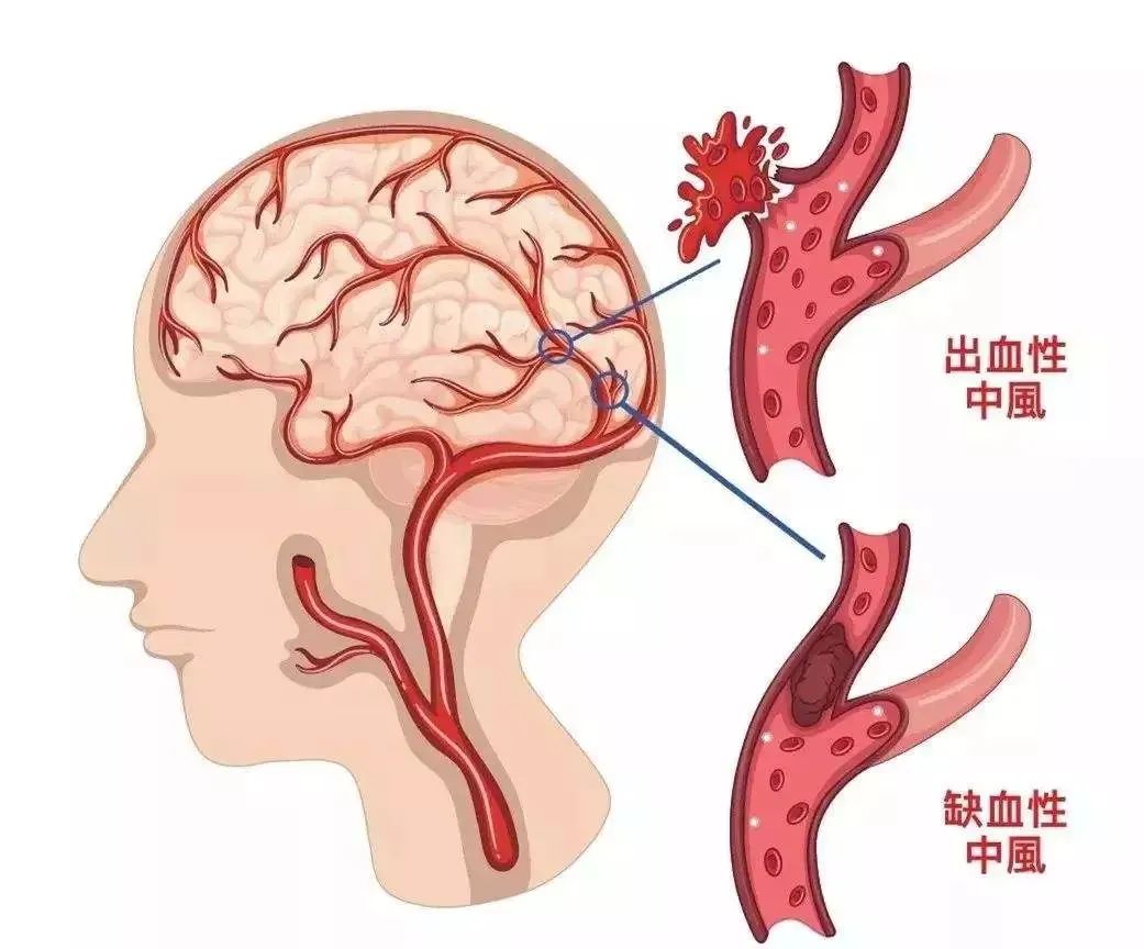 脑梗后遗症，让干细胞来为你分忧解难