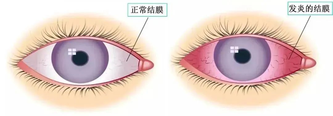 干细胞疗法：下一个过敏疾病的曙光，为过敏患者带来新机遇