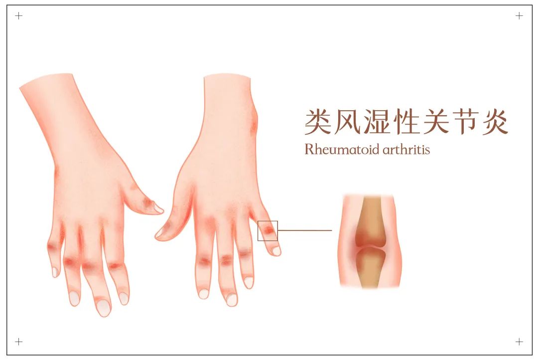 间充质干细胞,类风湿性关节炎临床方向的新选择!