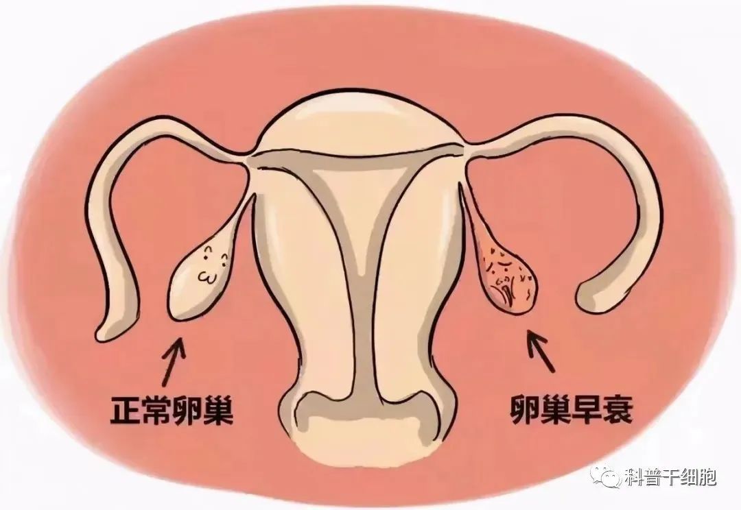 逆转更年期！干细胞解决卵巢早衰和提前闭经问题