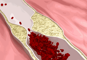 间充质干细胞：有效逆转慢性炎症，将癌症扼杀在摇篮中！