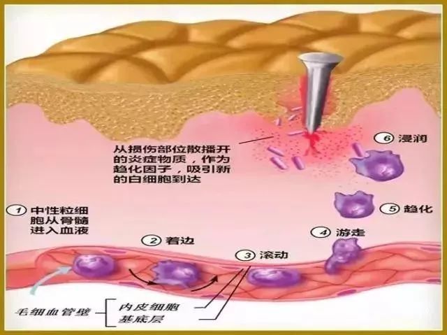 间充质干细胞：有效逆转慢性炎症，将癌症扼杀在摇篮中！
