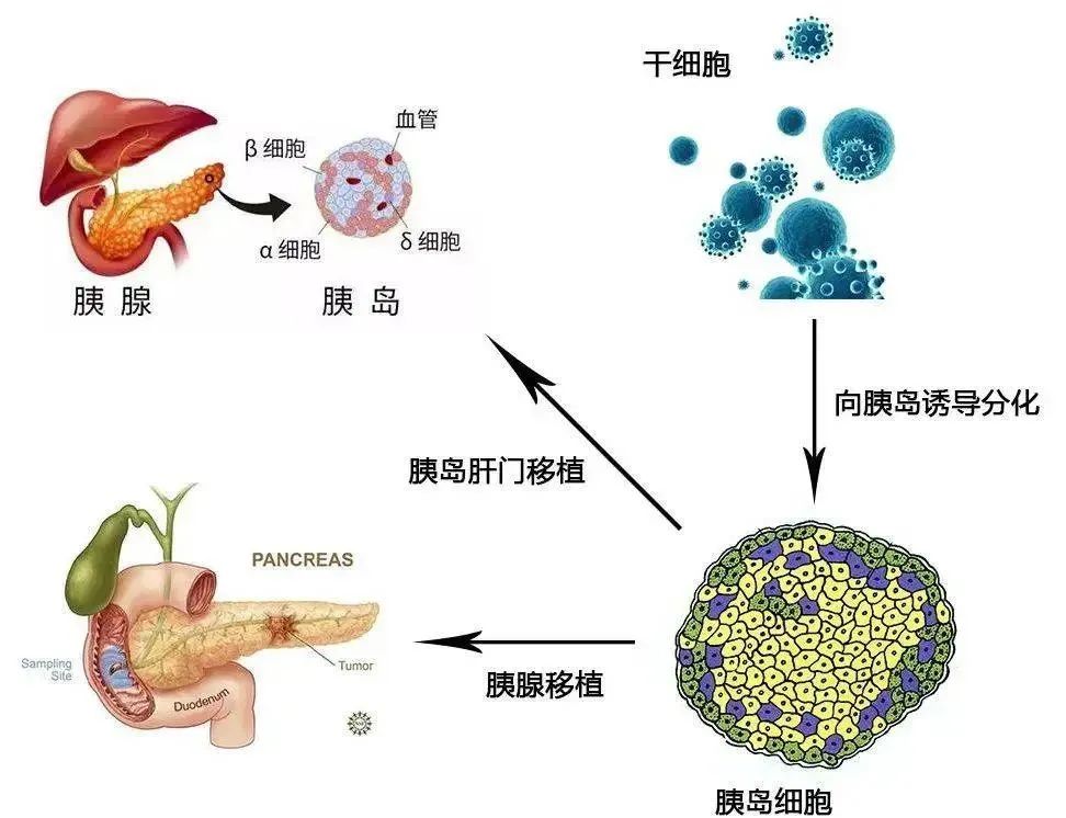 干细胞改善高血脂，有效预防“三高”并发症！