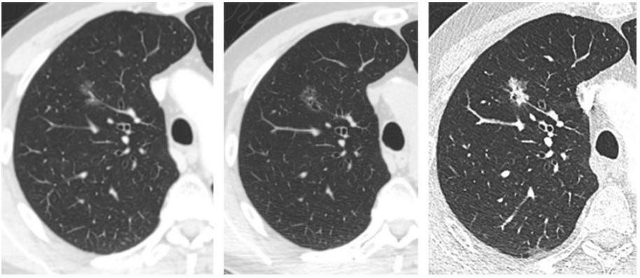 肺部结节“缩小术”：在癌变前，免疫细胞可使其缩小甚至消失