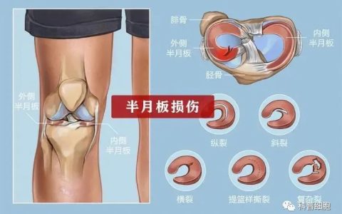 干细胞技术干预半月板损伤临床效果显著