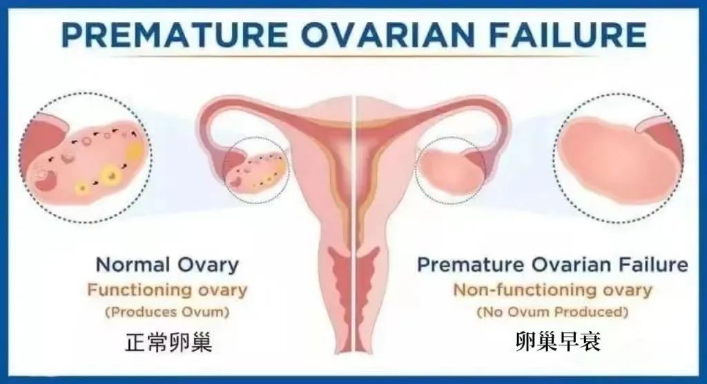 临床证实｜干细胞治愈卵巢早衰！痊愈10例，有效治疗13例，成功率高达92％