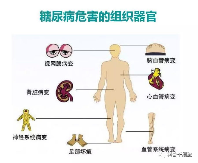 关于糖尿病并发症，干细胞能起到什么关键性作用？