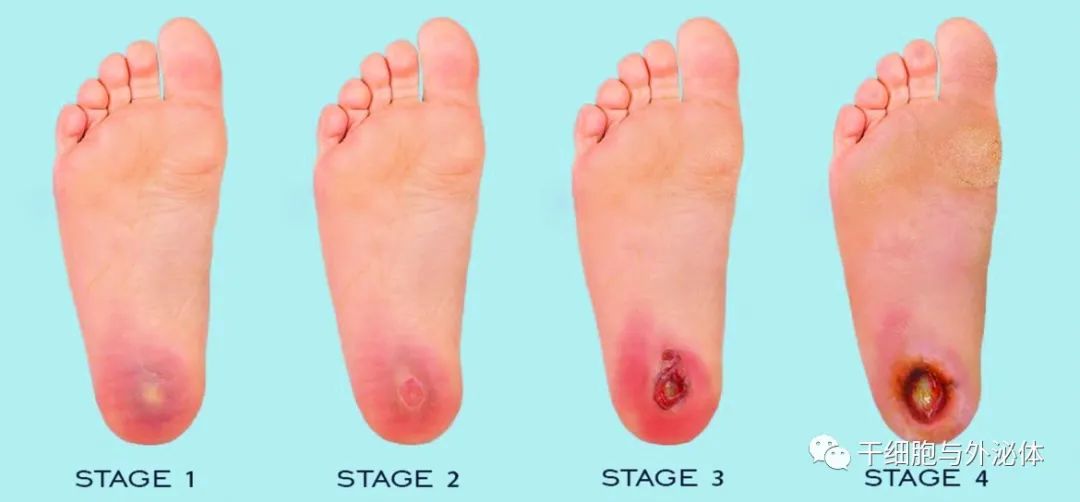 25 例 | 外泌体联合疗法治疗糖尿病足溃疡