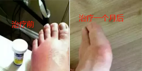 案例｜干细胞治疗痛风 ， 一次也没发作，尿酸指标恢复正常