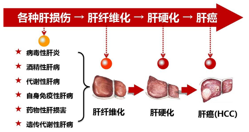 干细胞治疗肝硬化的作用与机制